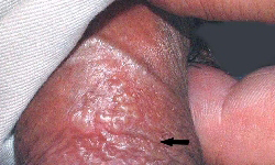 什么是男性原发性生殖器疱疹