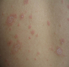 治疗玫瑰糠疹的一般方法是什么