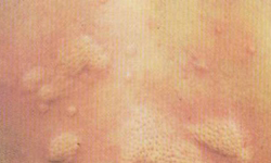 引发过敏性荨麻疹的原因都有哪些