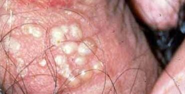 引起生殖器疱疹的主要原因是什么