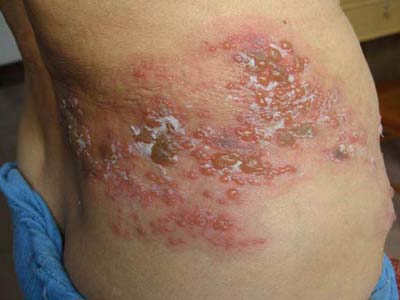 带状疱疹的诊断及其治疗