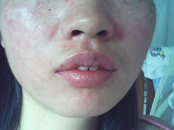 面部皮肤过敏的原因具体是什么