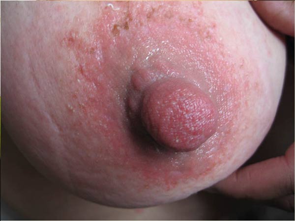  乳房湿疹的病因是什么