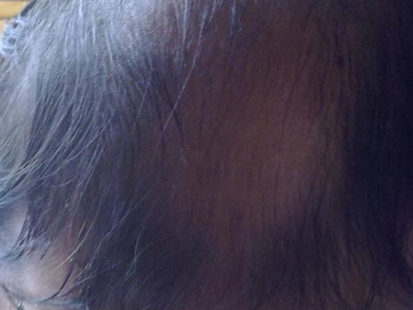 产后脱发的病因是哪些
