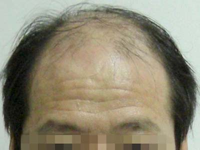 脂溢性脱发的症状是哪些呢
