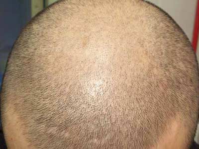 患有脱发是由什么病因导致的