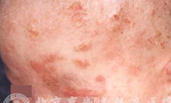 皮炎湿疹有什么症状