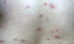 荨麻疹类过敏的有什么症状
