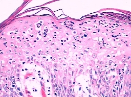 女性尖锐湿疣病毒早期区