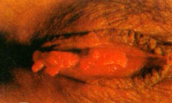 尖锐湿疣病毒与宫颈癌密切相关