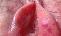 复发性生殖器疱疹的症状是什么