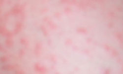 螨虫引起的皮肤过敏应该如何预防