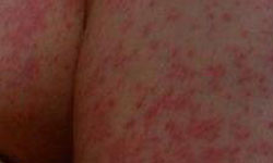 青霉素能够引起皮肤过敏吗