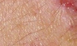 青霉素为什么能够引起皮肤过敏