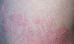 青霉素什么情况下会引起皮肤过敏