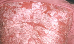 红皮病型银屑病会导致全身的危害