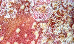 泛发性脓疱型银屑病导致内脏器官的损害