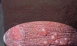 性病生殖器疱疹的初期症状有什么