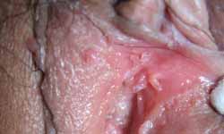 尖锐湿疣感染皮损的初期症状