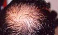 脂溢性脱发的临床表现是什么