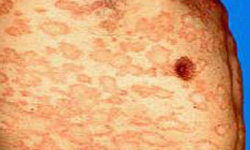 玫瑰糠疹需与哪些疾病鉴别