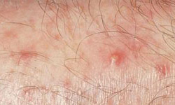 毛囊炎的皮损特点是什么