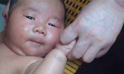 宝宝患有湿疹如何护理