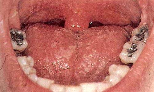 尿道口红肿症状图图片