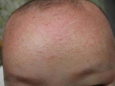 怎么发现预防小孩皮肤过敏