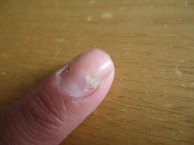 灰指甲症状图片