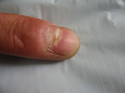 怎么预防灰指甲复发