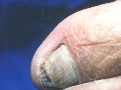 灰指甲患者怎么避免传染身边人