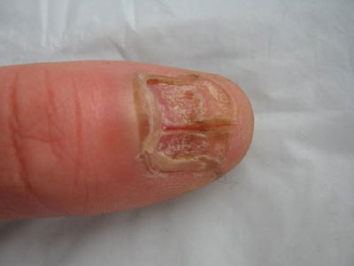 灰指甲疾病的护理措施