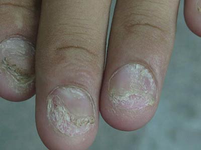通常患了灰指甲会有什么表现