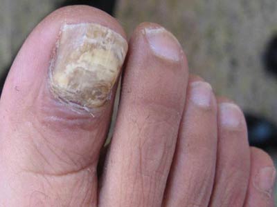 脚趾灰指甲怎么治疗
