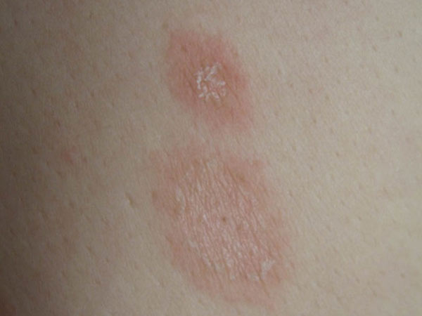 玫瑰糠疹具体有哪些预防措施
