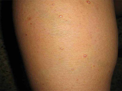 银屑病型皮肤有什么症状