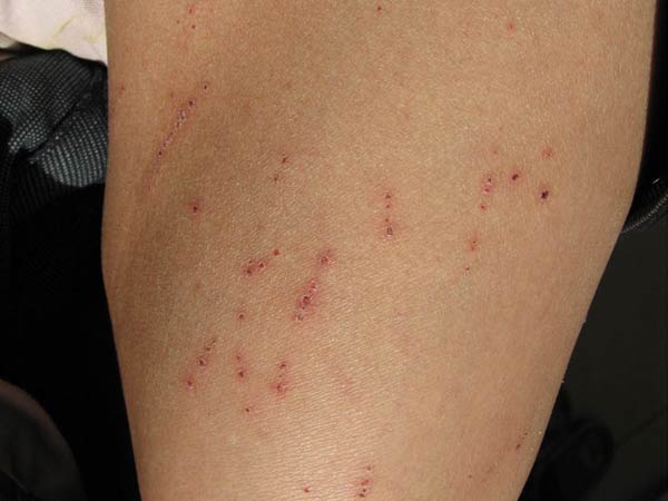 皮肤瘙痒症有什么样的危害