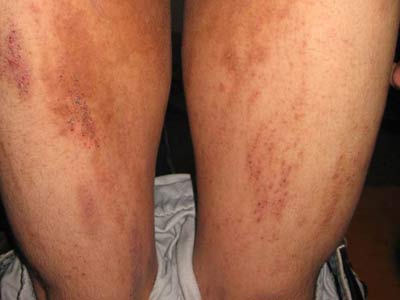皮肤瘙痒是因为什么病因导致