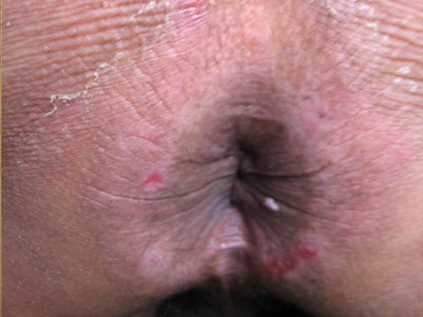 肛周湿疹反复发作的治疗