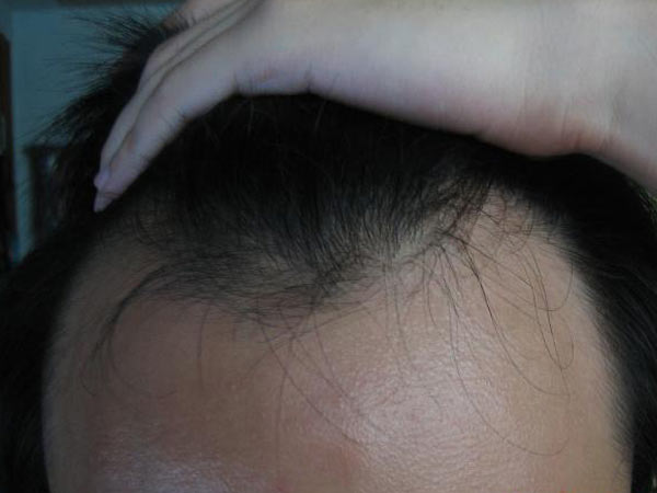 治疗脱发可以用什么方法
