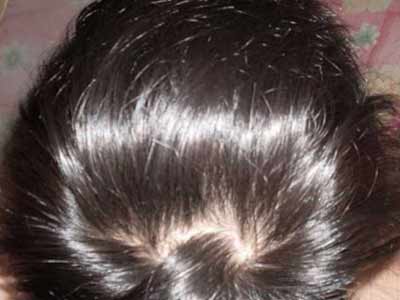 女性出现产后脱发的病因是什么