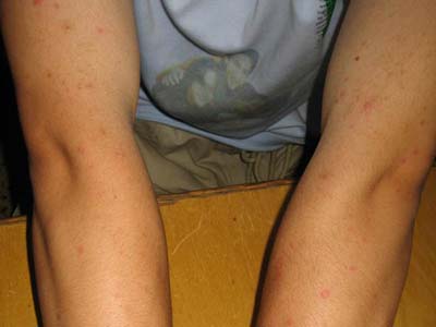 过敏性荨麻疹的病因有哪些