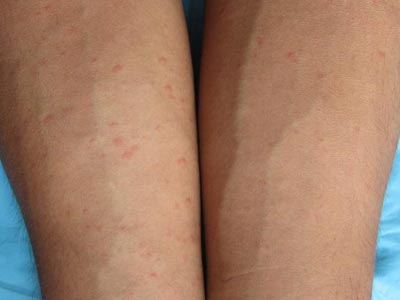 过敏性荨麻疹的具体症状有哪些