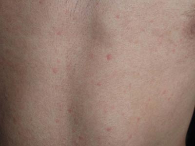 过敏引起的荨麻疹怎么治