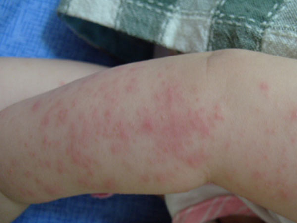 婴儿湿疹的危害性