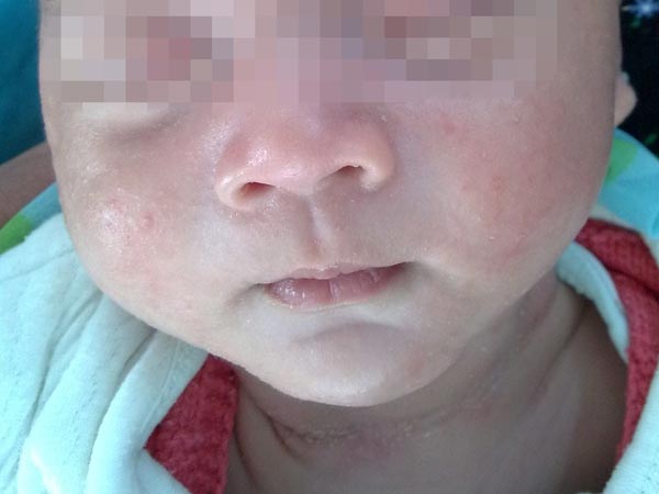 婴儿脸上的湿疹怎么办