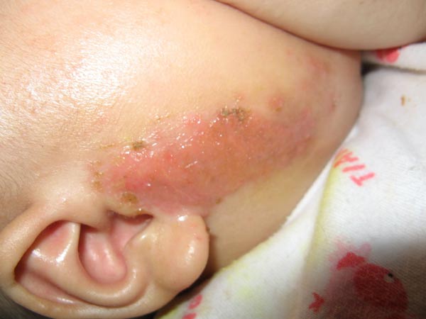 患上婴儿湿疹有什么病因