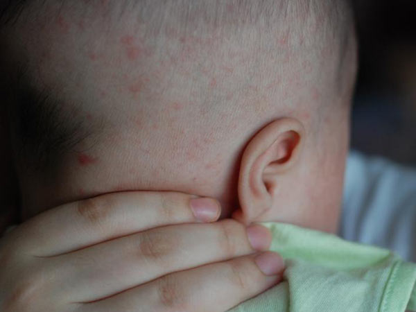 婴儿湿疹什么原因诱发的