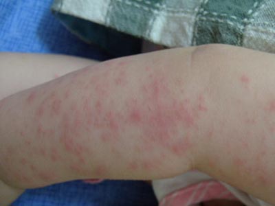 儿童患有湿疹会出现的症状